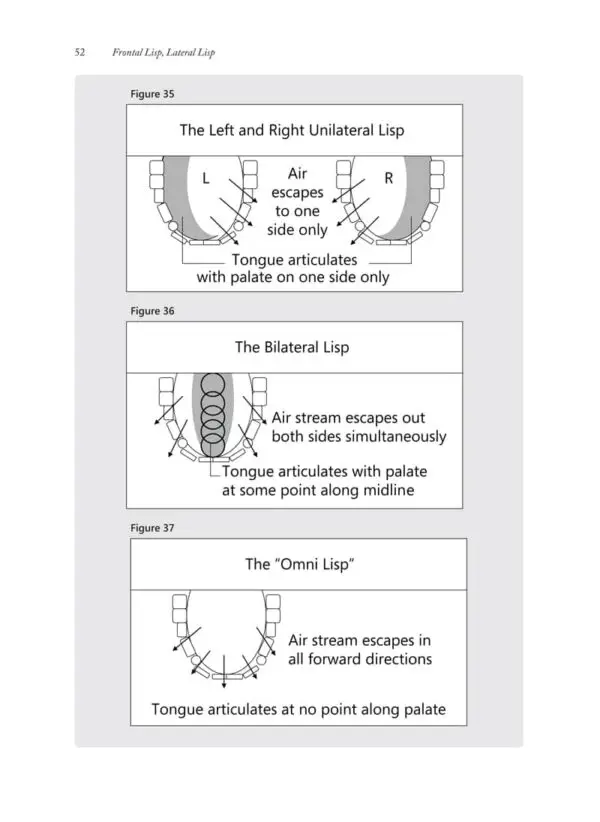 Frontal Lisp, Lateral Lisp - Image 4